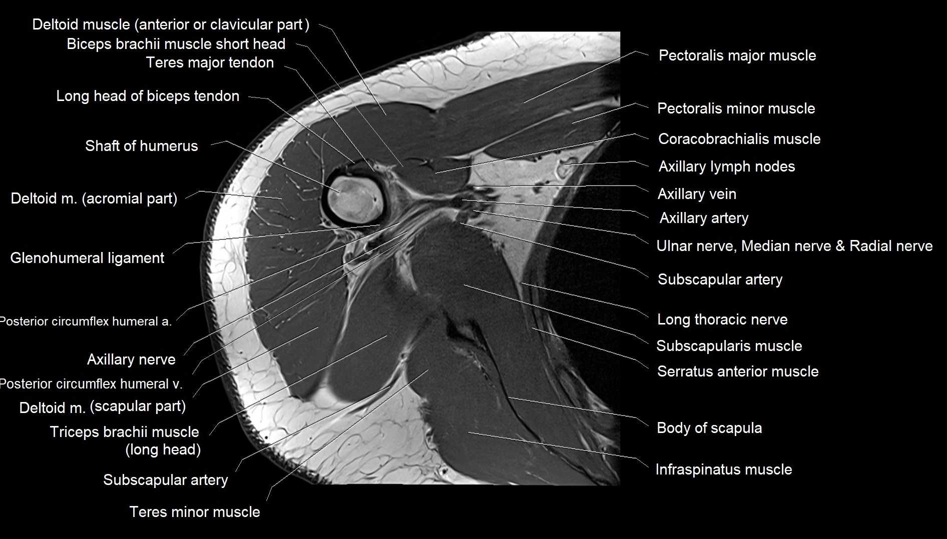 Shoulder cross sectional anatomy MRI 3T axial image 31.webp